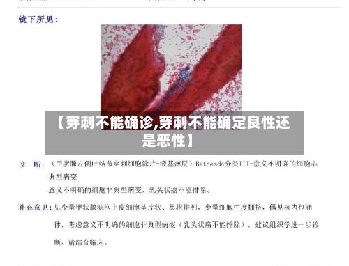 【穿刺不能确诊,穿刺不能确定良性还是恶性】-第3张图片