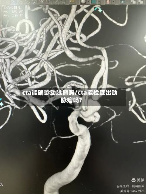 cta能确诊动脉瘤吗/cta能检查出动脉瘤吗?-第3张图片