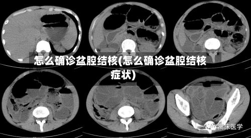 怎么确诊盆腔结核(怎么确诊盆腔结核症状)