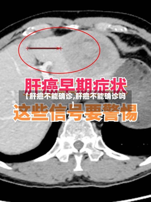 【肝癌不能确诊,肝癌不能确诊吗】-第2张图片