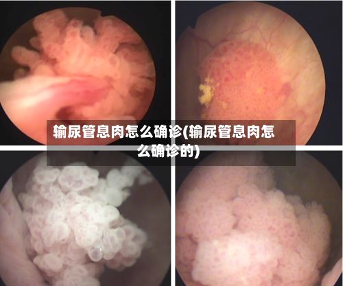 输尿管息肉怎么确诊(输尿管息肉怎么确诊的)