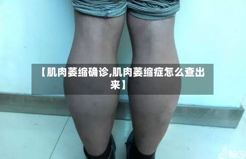【肌肉萎缩确诊,肌肉萎缩症怎么查出来】-第3张图片