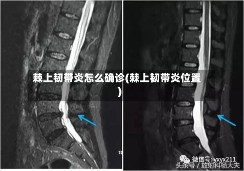棘上韧带炎怎么确诊(棘上韧带炎位置)-第3张图片