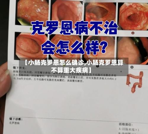 【小肠克罗恩怎么确诊,小肠克罗恩算不算重大疾病】-第2张图片