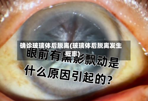 确诊玻璃体后脱离(玻璃体后脱离发生概率)