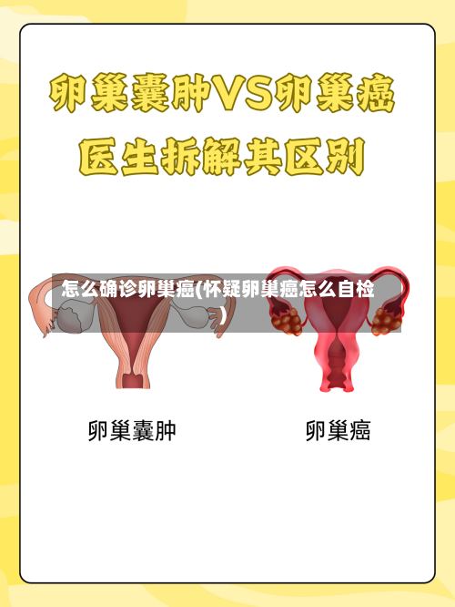 怎么确诊卵巢癌(怀疑卵巢癌怎么自检)