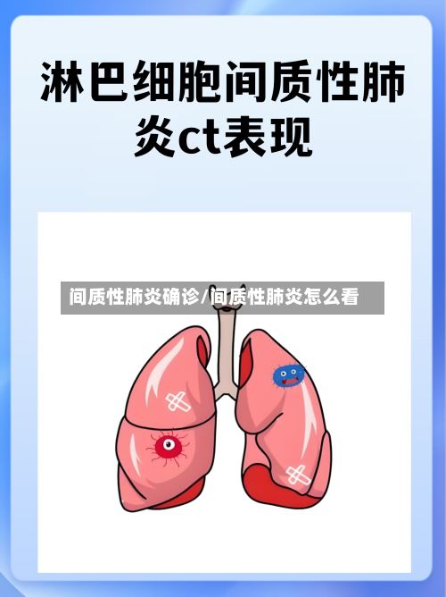 间质性肺炎确诊/间质性肺炎怎么看