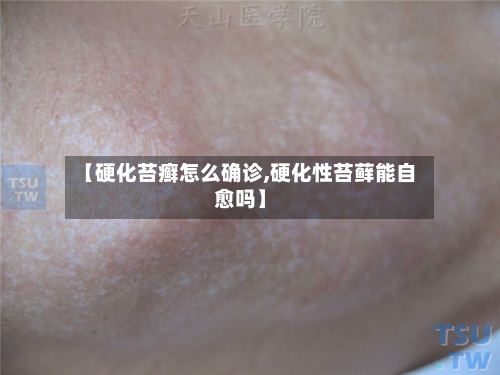【硬化苔癣怎么确诊,硬化性苔藓能自愈吗】-第2张图片