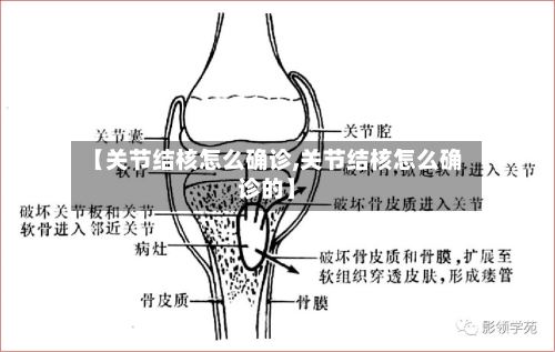 【关节结核怎么确诊,关节结核怎么确诊的】
