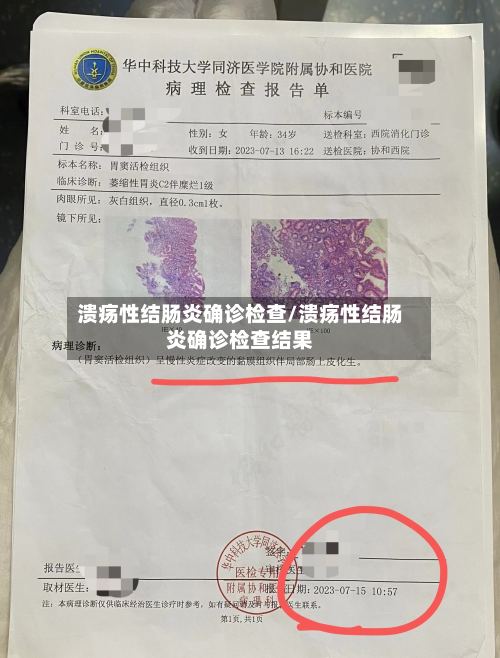 溃疡性结肠炎确诊检查/溃疡性结肠炎确诊检查结果-第2张图片